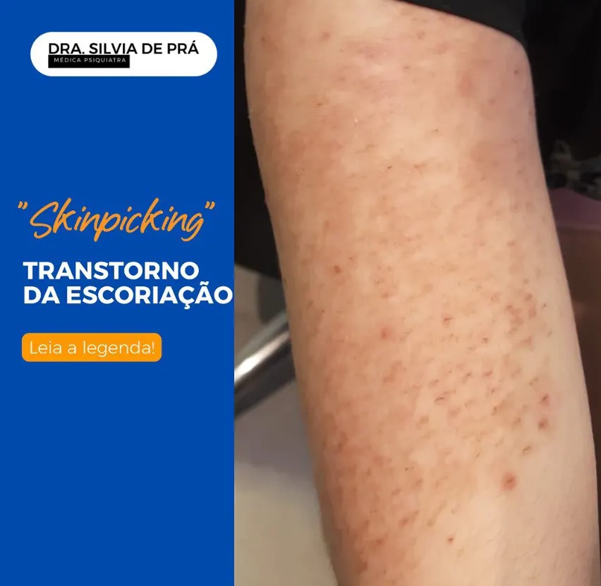 "Skin Picking" Transtorno da Escoriação
